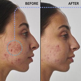 Scar, mark and wrinkle solution with 1% retinol - Face serum