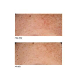 Alpha Beta® - Universal Daily Peel
