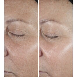 Clinique Smart Clinical Repair™ Wrinkle Correcting Serum - Αντιγήρανση