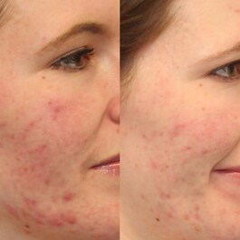 Outsmart Blemish - Clarifying Treatment