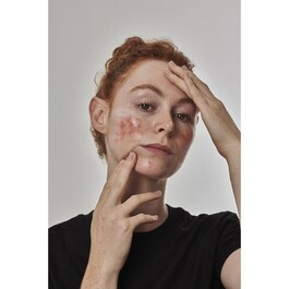 Redness Solution with 10% Azelaic - Face Serum