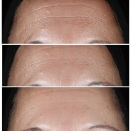 Clinique Smart Clinical Repair™ Wrinkle Correcting Serum - Αντιγήρανση