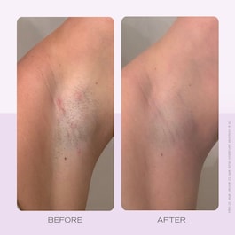Ingrown Hair Pads - Δίσκοι για τρίχες που γυρίζουν προς τα μέσα x60 