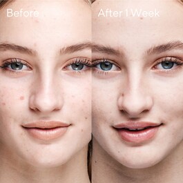 Outsmart Blemish - Clarifying Treatment
