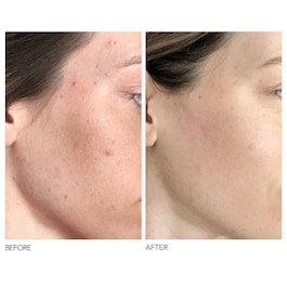 Alpha Beta® - Universal Daily Peel