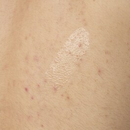 Salicylic Acid 0.5% Body Serum — Ορός κατά των ατελειών του σώματος