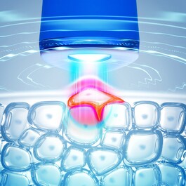 ESPADA ™ - Blue Pulsed Light Acne Device