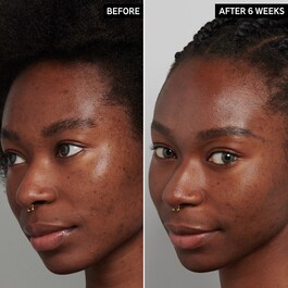 Tranexamic Acid Hyperpigmentation Night Treatment